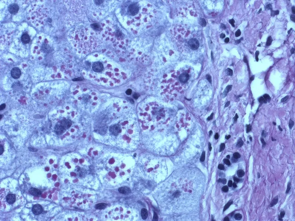 Liver cells packed with stuck alpha-1 antitrypsin (pink-red globules): the misfolded protein BEAM-302's one-letter fix targets