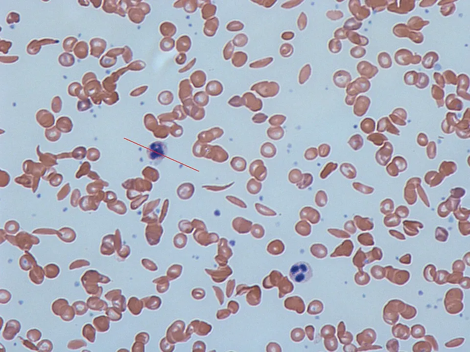 Sickle-shaped red blood cells in a blood smear: the disease risto-cel treats by switching fetal hemoglobin back on