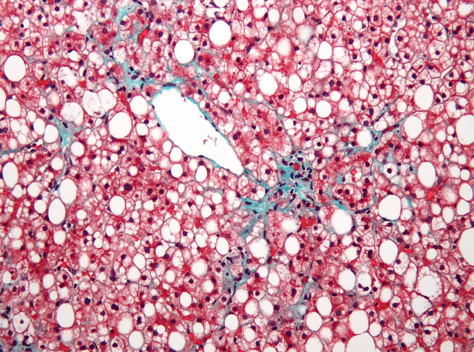 A fatty liver under the microscope (white fat droplets): the liver fat retatrutide's glucagon signal helps burn off