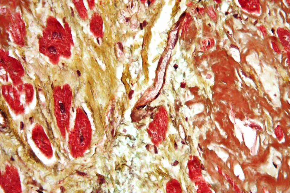 Heart muscle clogged by amyloid under the microscope: the misfolded protein deposits that switching off TTR aims to stop