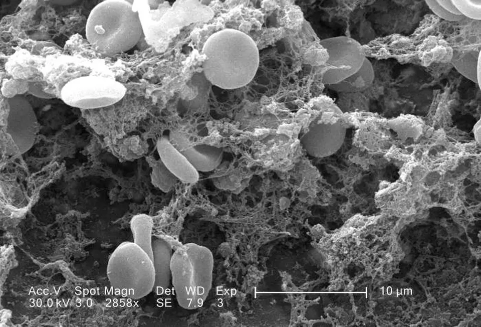 A blood clot in an electron microscope: red cells caught in fibrin mesh; PAI-1 blocks the enzymes that dissolve clots like this