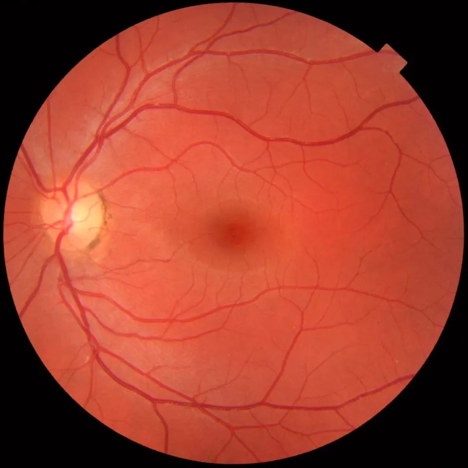 The back of a healthy eye: the bright disc is where the optic nerve leaves, the cells ER-100 aims to make young again