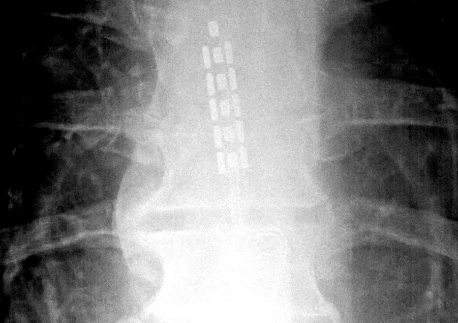 X-ray of a paddle of stimulating electrodes lying on the spinal cord (a pain-therapy device): ARC-IM places a similar paddle