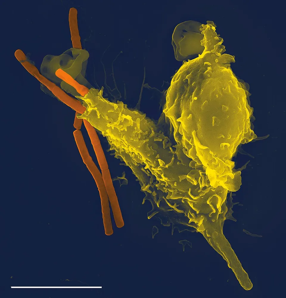 A neutrophil (yellow) grabbing bacteria: the germ-killing white cells that PM359's edited stem cells should restore