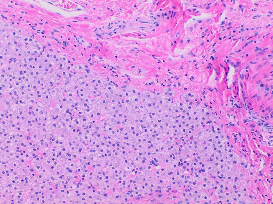 Human liver cells under the microscope: the cells that handle copper and that PM577a's prime editor is carried into