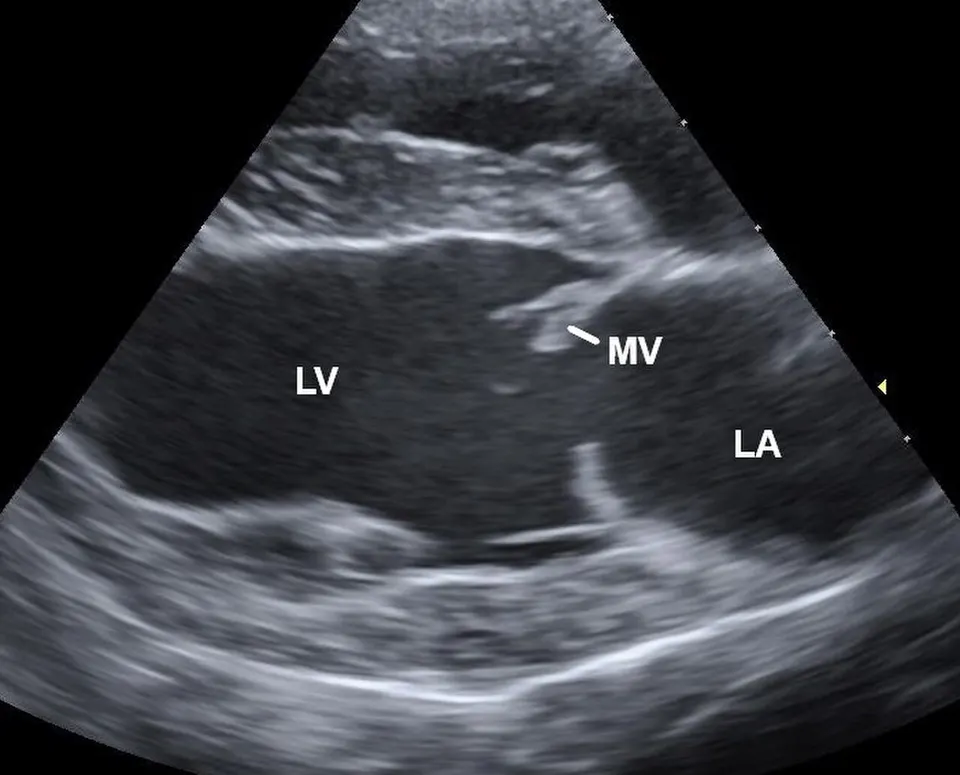 Ultrasound of a dog's heart with mitral valve disease (MV: the valve): the valve wear this gene therapy aims to slow