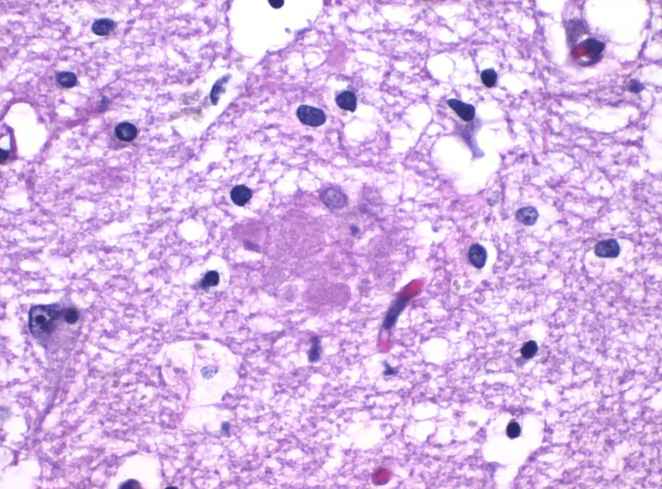 An amyloid plaque in an Alzheimer's brain: the protein clumps that restarting autophagy, the cell's cleanup, aims to clear