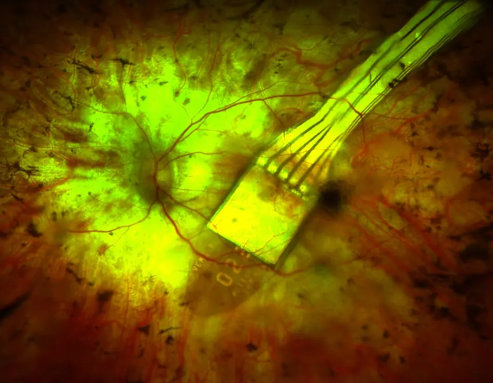 A light-sensing chip seen under the retina at the back of an eye (an earlier German implant): PRIMA's chip sits in the same spot